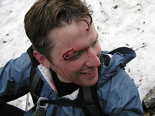 I took a fall at Headlee Pass, descending from Vesper Peak.  32 stitches.